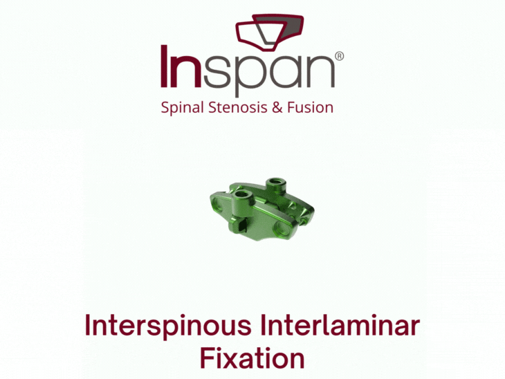 Inspan - ScrewLES® Spine Surgery