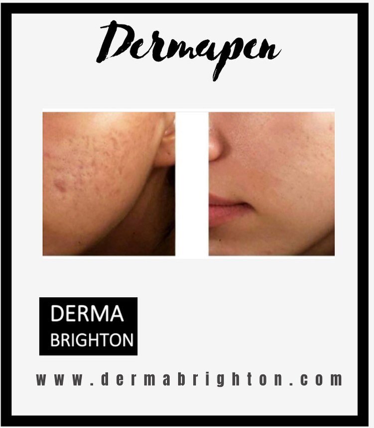 🖤Dermapen
Fantastic results for clients on courses of 6 Dermapen treatments.
Dermapen skin needling also known as microneedling is increasingly being accepted as one of the most innovative rejuvenation therapies available today for keeping your skin