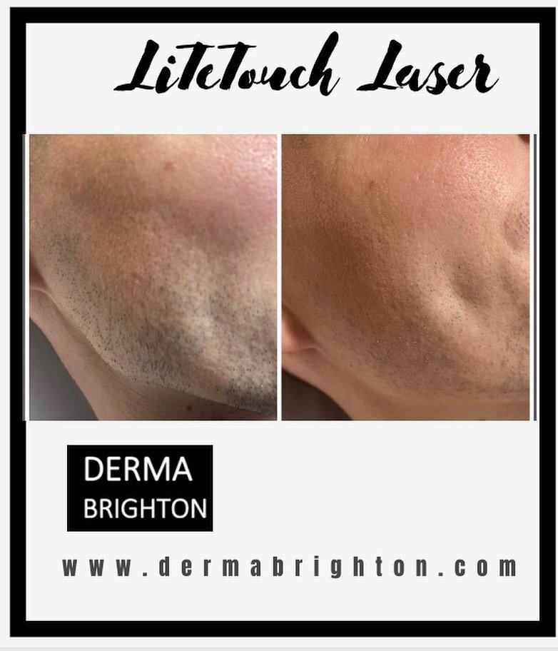 🖤LiteTouch Laser
Both photos are before and after 1 session of LiteTouch laser! Amazing results and reduction already.
I can honestly say I have never worked with a machine this good😊
Book a free patch test
www.dermabrighton.com
#lasehairremoval #l