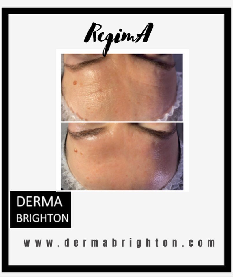 🖤 RegimA Peels
🖤Dermaplaning
🖤Lash lift
🖤Profhilo 

Just a few of the glowing faces over the last two days✨
This week is so busy.
Thank you gorgeous clients 🖤

www.dermabrighton.com
#regima #regimaskincare #regimatreatments #powerpeel #chemicalp