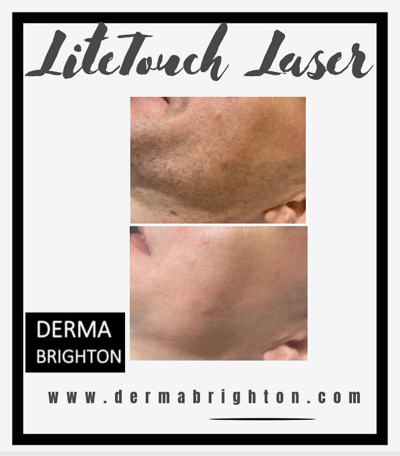🖤 LiteTouch Laser 
Amazing reduction for my client on coarse facial hair- this is before and afer 3 sessions 🎉
Absolutely love this laser machine- it works and it&rsquo;s pain free!

Book a free consultation and patch test online
www.dermabrighton.