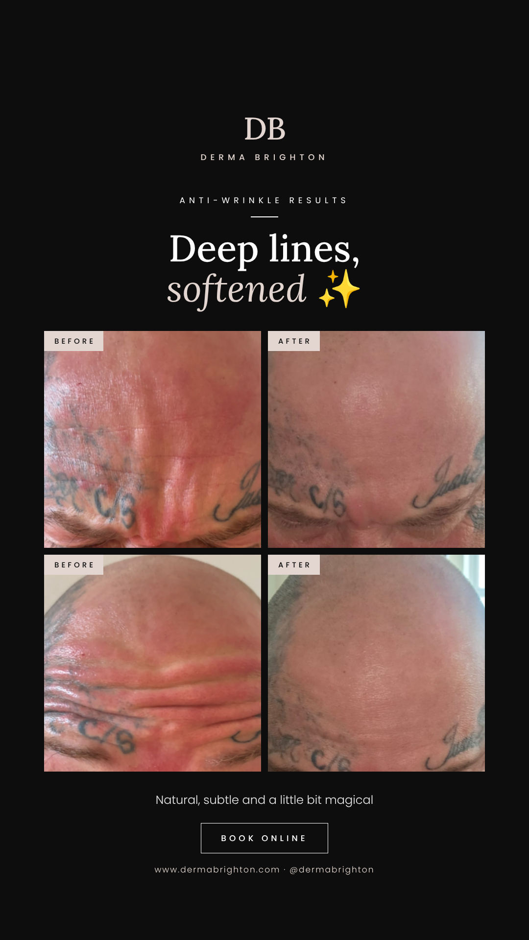 Derma-Brighton-anti-wrinkle-story.png