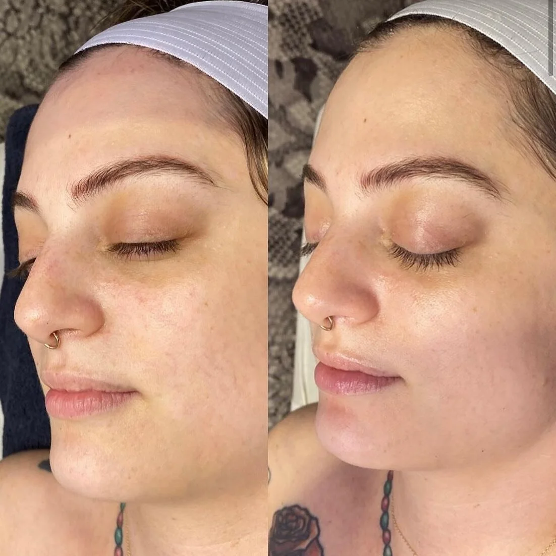 Before and after deep cleansing facial by @alexandria.aesthetix ✴️ depuffed ✔️redness reduced ✔️spider veins faded with high frequency enhancement ✔️ brightened tone ✔️ even texture ✔️ book your next facial appointment with us today! Link to book in 