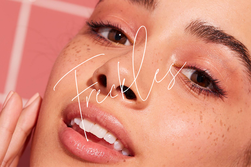 Freckles