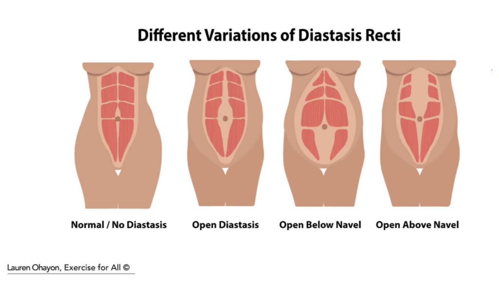  Diastasis Recti