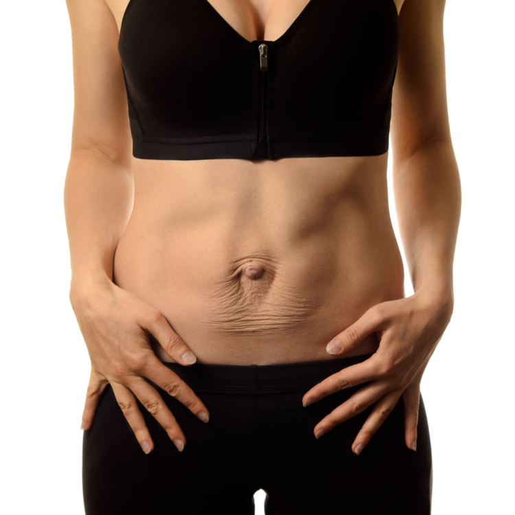 KALO Cosmetic Surgery - Rediscover Confidence👉【 #Tummy #Tuck 】for  Diastasis Recti . Are you tired of feeling self-conscious about your  postpartum belly bulge? 🤰🤱Pregnancy is a beautiful journey, but it can  leave