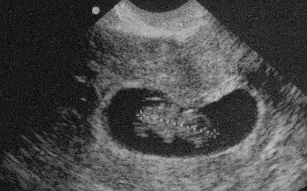 Third time lucky: Our story of pregnancy and miscarriage