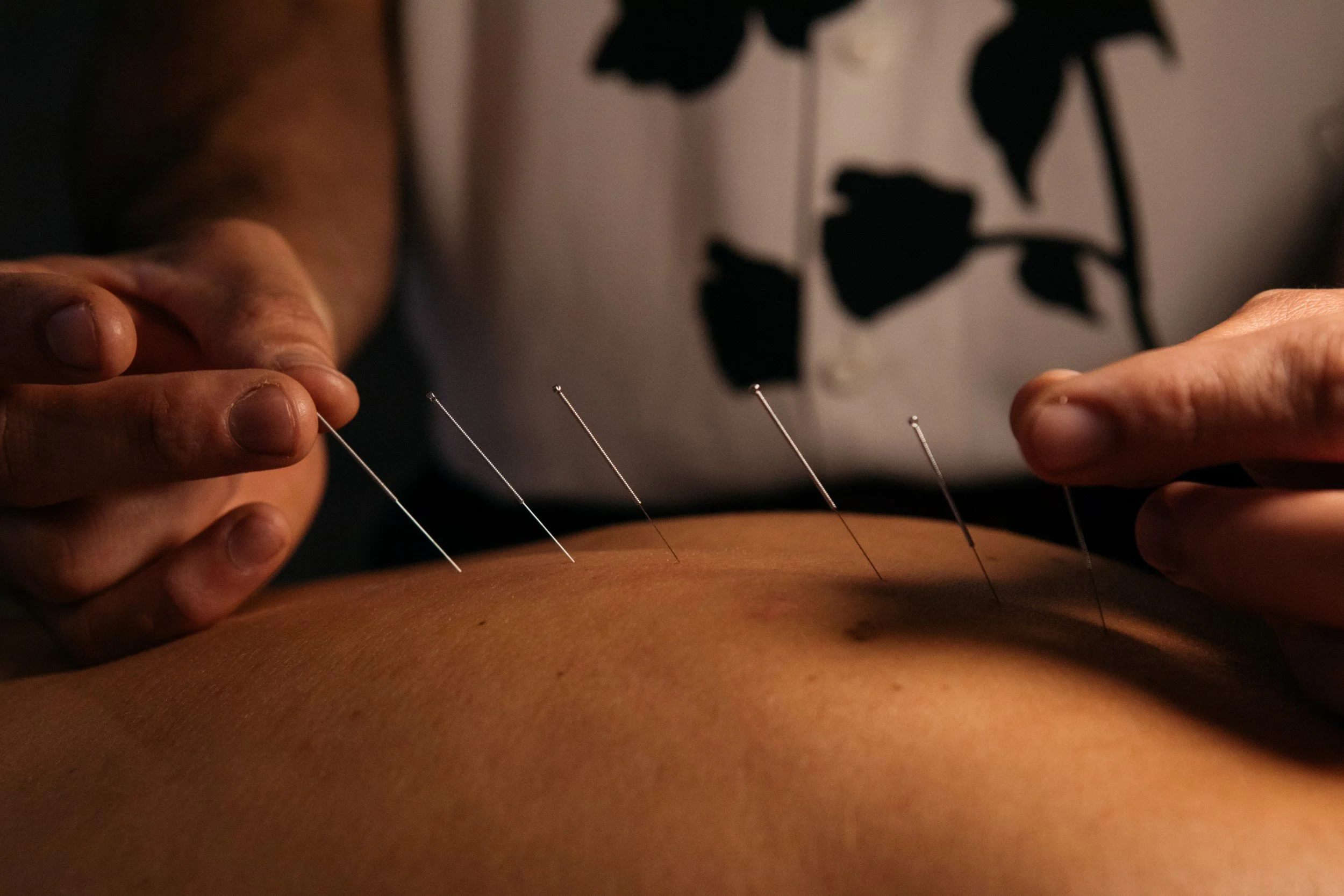 Classical treatment for insomnia and chronic fatigue treatment at Gateway Acupuncture in Hillcrest San Diego