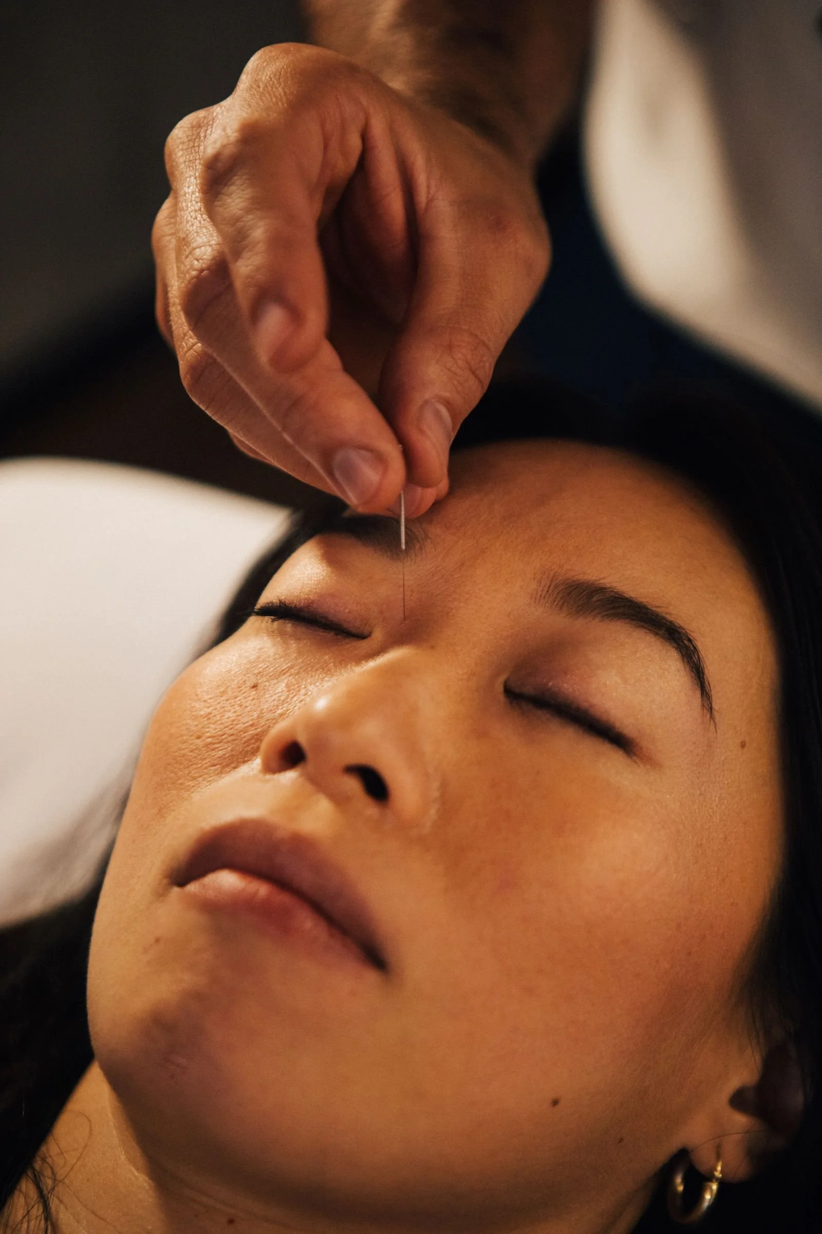 Classical Acupuncture Needling Bladder One Divergent Acupoint Hillcrest San Diego