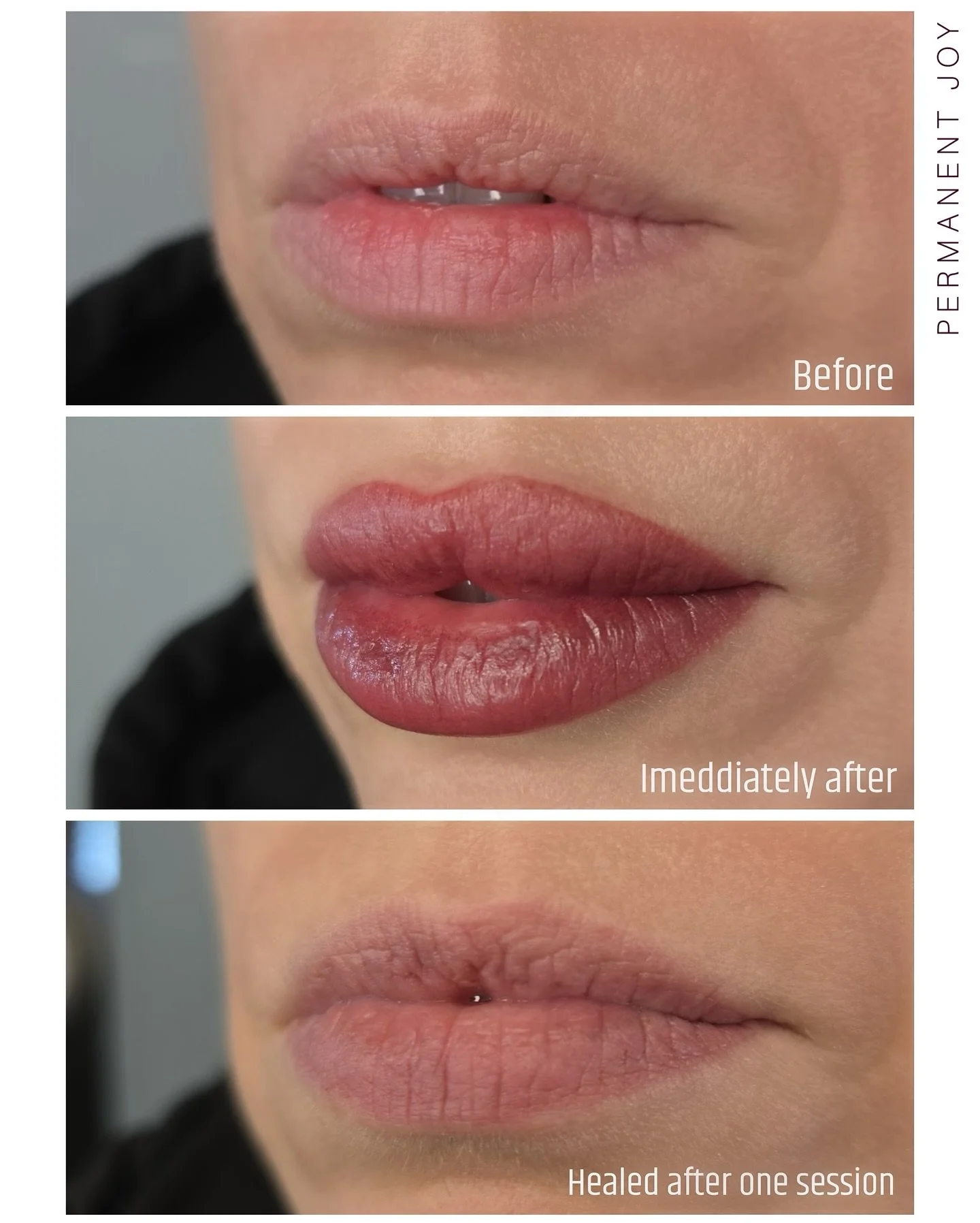 Subtle changes are honestly my favorite kind of work.
I love enhancing lips just enough&mdash;taking them from pale to noticeable, while keeping everything soft and natural.
This is one of my recent clients. She was already happy after the first sess