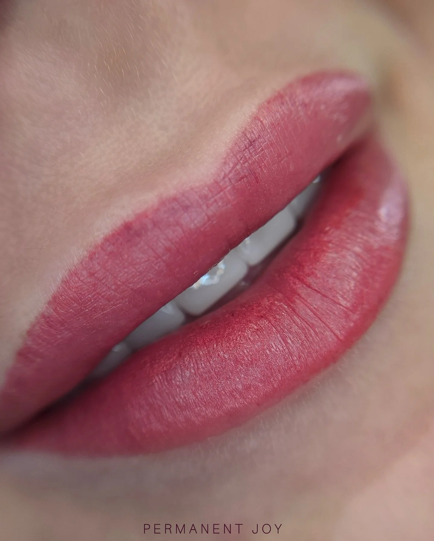 Beautiful lips right after the procedure 💋✨

What you see here is a real, unedited result with no retouching. Slight swelling or small bruises right after the procedure are completely normal and part of the natural healing process. You may notice a 