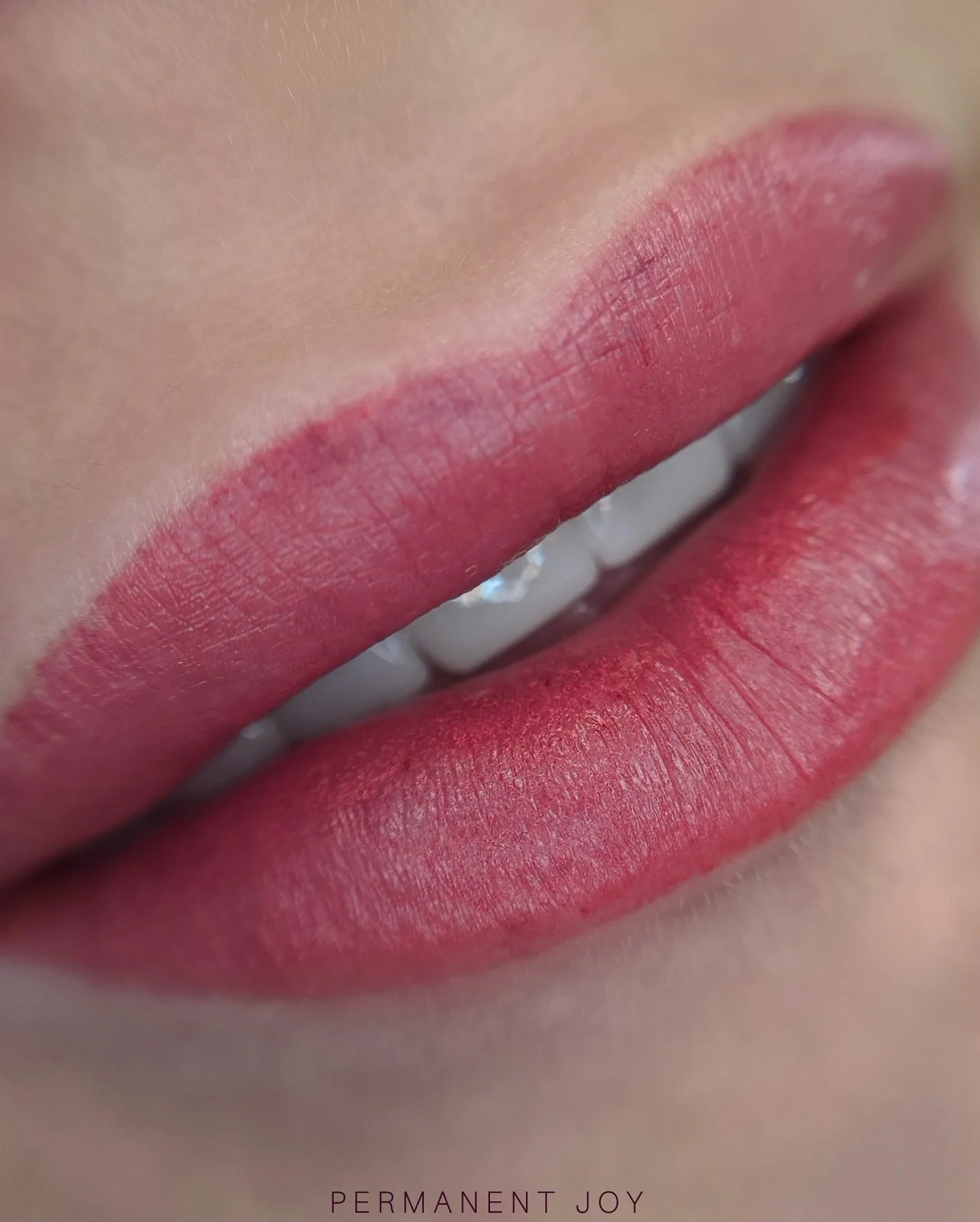 Lips right after the procedure 💋✨ 

It&rsquo;s completely normal to see a little swelling, small bruises, or unevenness right after the session. What you see in this photo is actually a very good, healthy result.

This happens quite often, and there