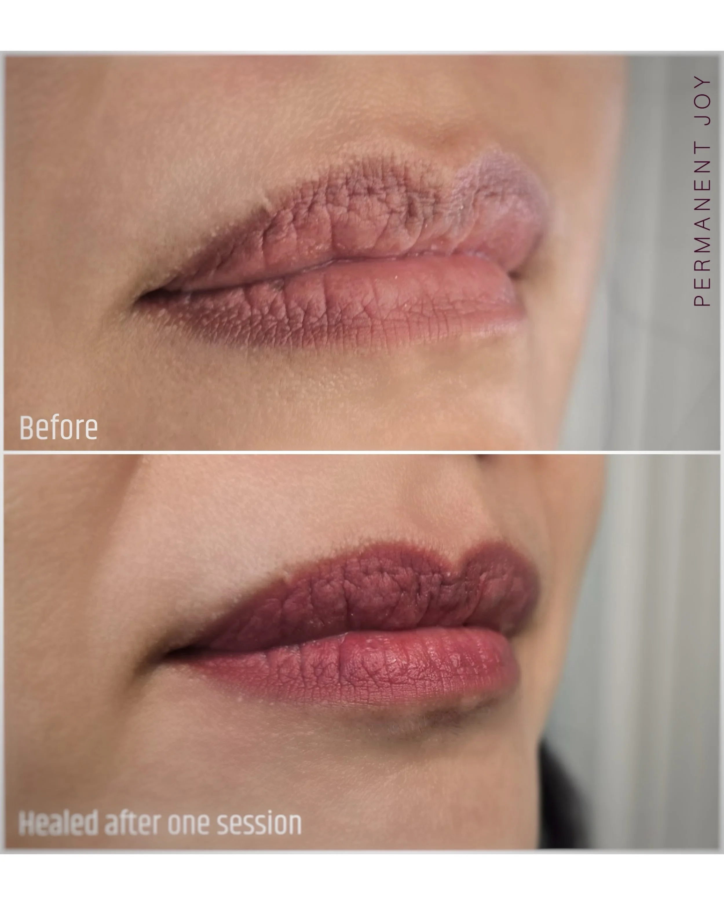 Lips Neutralization &amp; Warming Up ✨💋

This is a very good example of lips neutralization and warming up. Here you can see the before and the healed result after just one session ✨

I decided not to include the immediate after photo because the li