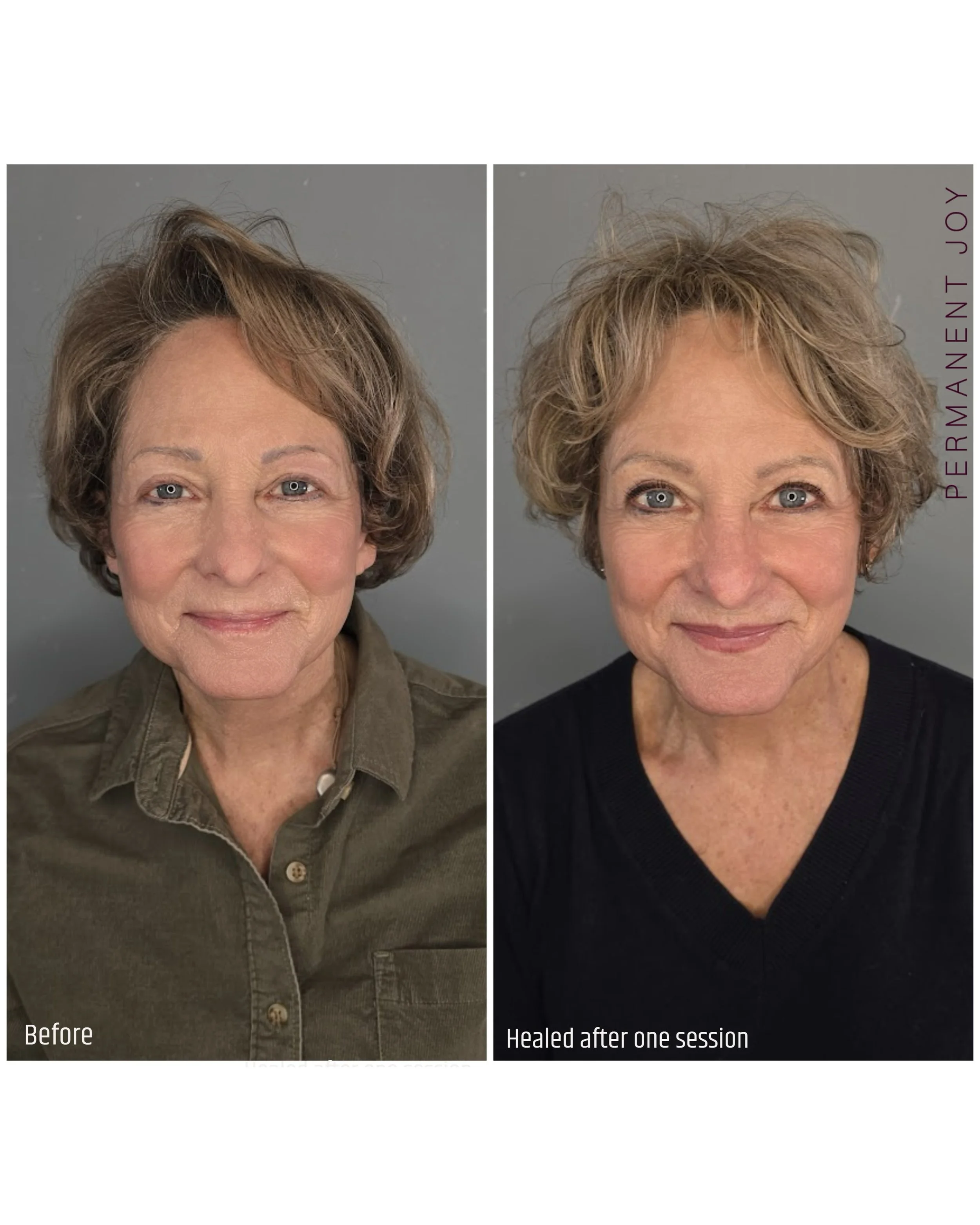 Brows + Lips Combo ✨

Before &amp; After 💕

This was a beautiful combo transformation for both brows and lips ✨

For the brows, we worked on covering very old permanent makeup from the 90s. Originally they were thin black &ldquo;thread brows&rdquo; 