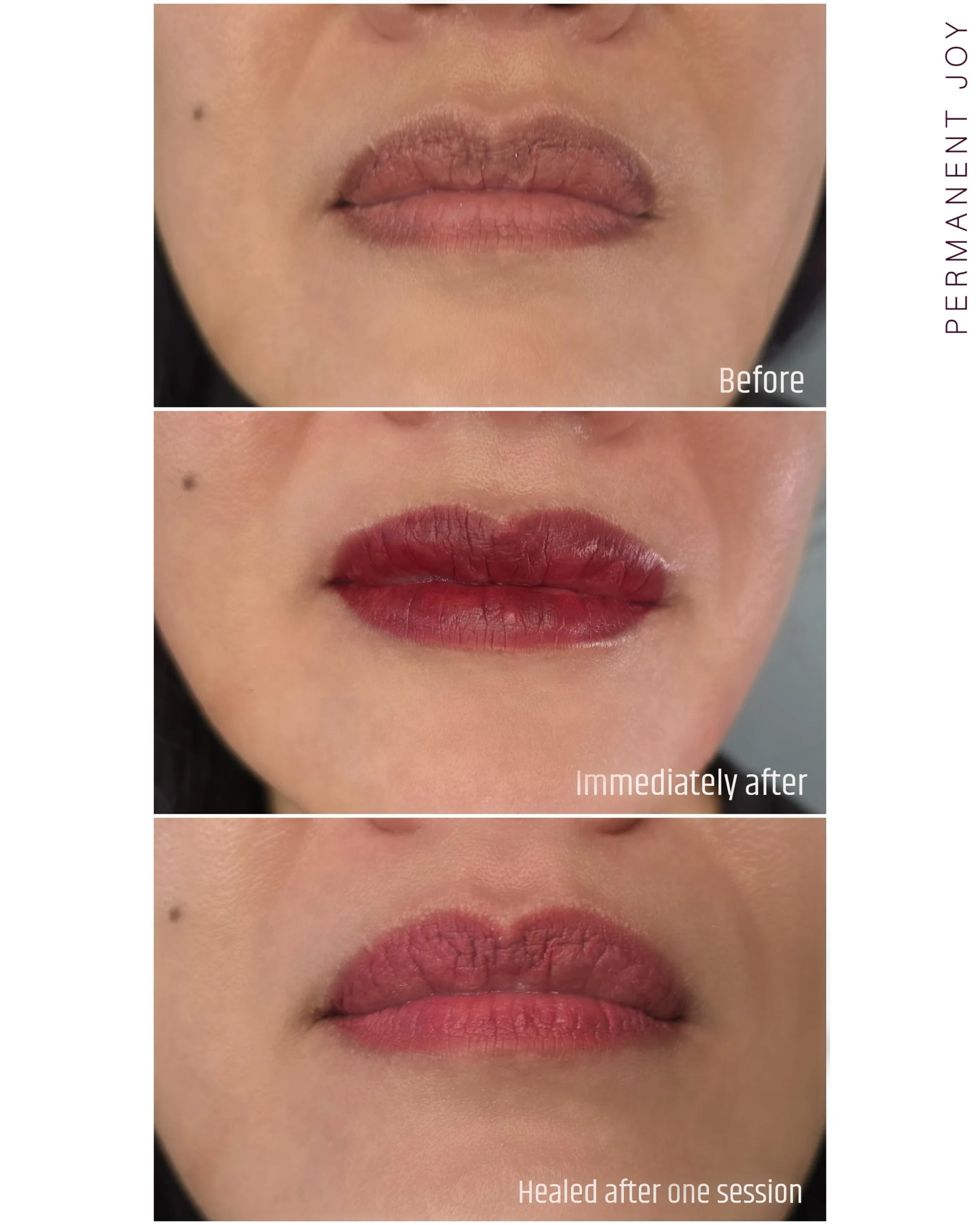 ✨ Lip neutralization + correction of uneven pigmentation after just ONE session ✨

In this case, we focused on evening out the lip color, softening the darker border, and improving the overall appearance and shape of the lips 💋

You can still slight
