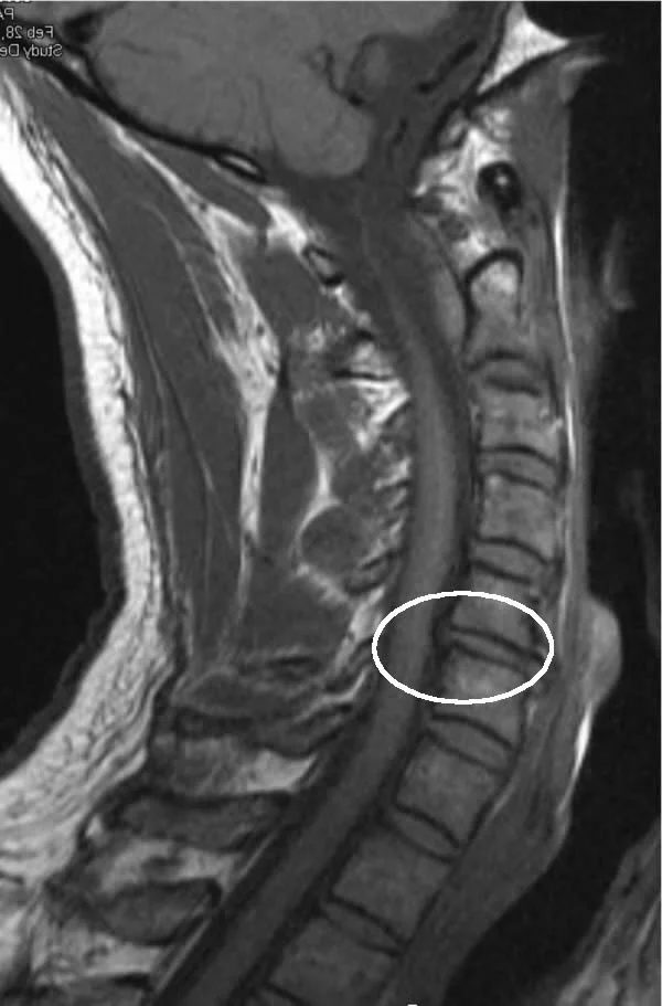 Bulged Disc in Neck Longwood, Florida — Premier Performance and