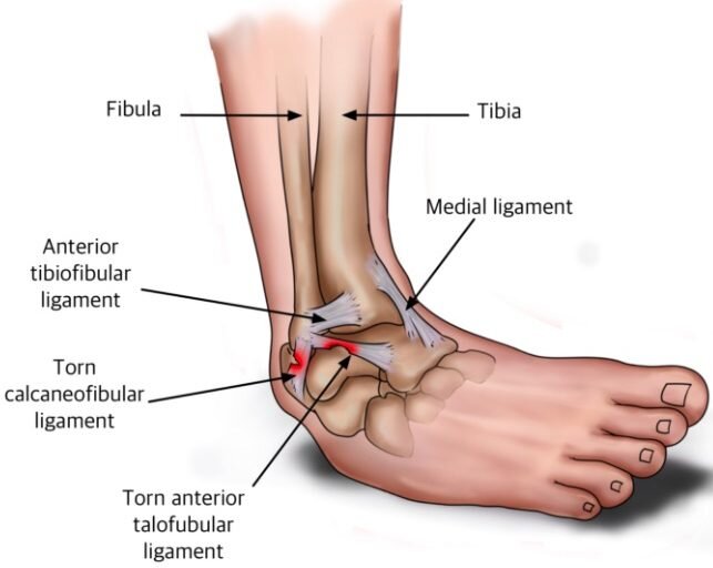 Plantar Fasciitis: The Most Likely Cause of Your Heel Pain | PTSMC Blog