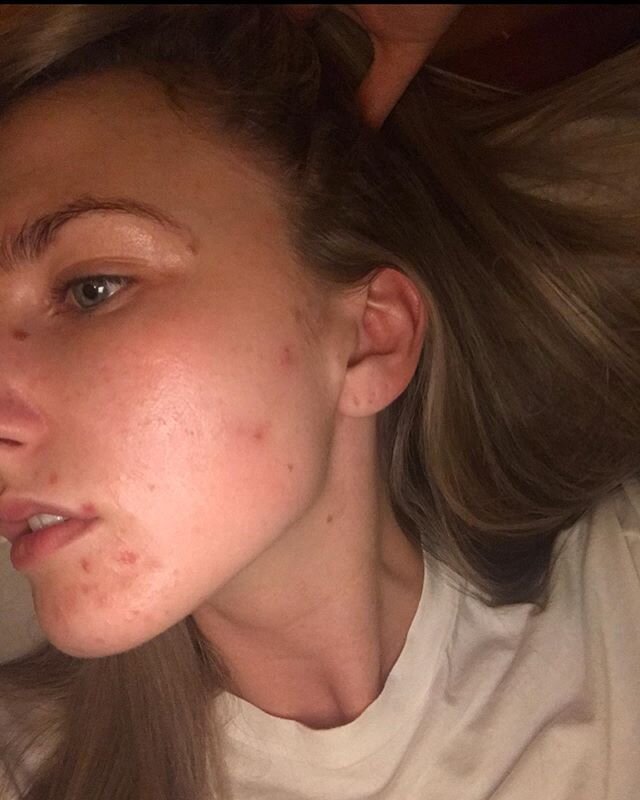 This is a BIG thing for me to post as I&rsquo;ve always been so self conscious about my skin. About a year ago my skin become so spotty, red and irritated. I was so upset about it and would hide under layers of makeup... BUT I just want to show you t