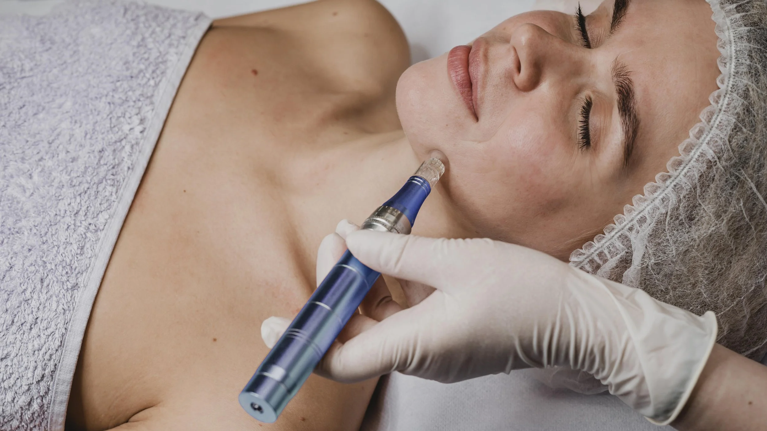 Microneedling