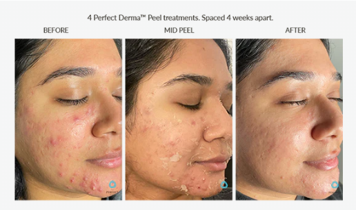 Before and after results of four monthly Perfect Derma Peels