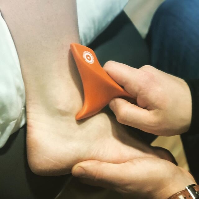 Using a tool to aid in soft tissue therapy can be extremely effective!
⠀
➕ In conjunction with our hands it helps mobilize lasting edema surrounding tissues and nerves that can sensitize the area.⠀
⠀
➕ In the case seen above, the patient had recurren