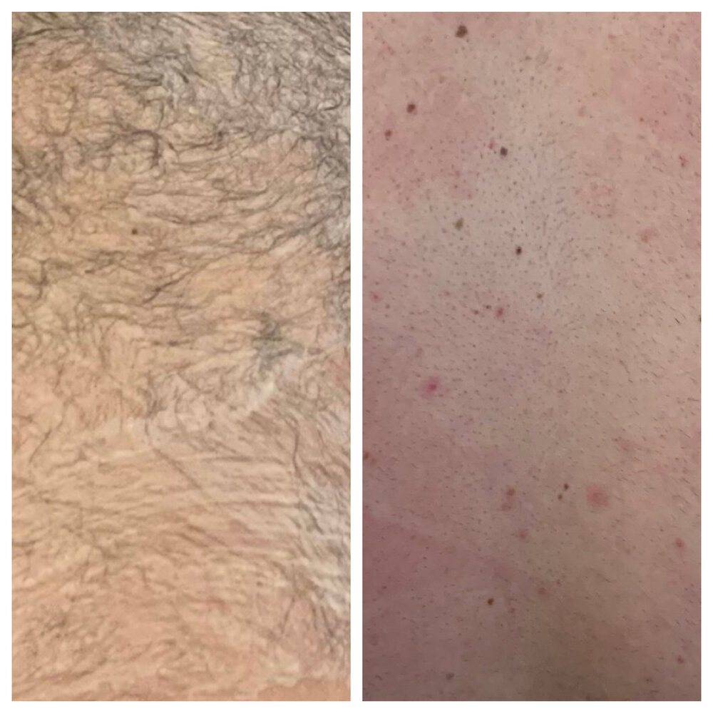 Laser Hair Removal, Columbia, SC — The Art of Aesthetics Med Spa, LLC Laser Hair Removal, Columbia, SC — The Art of Aesthetics Med Spa, LLC