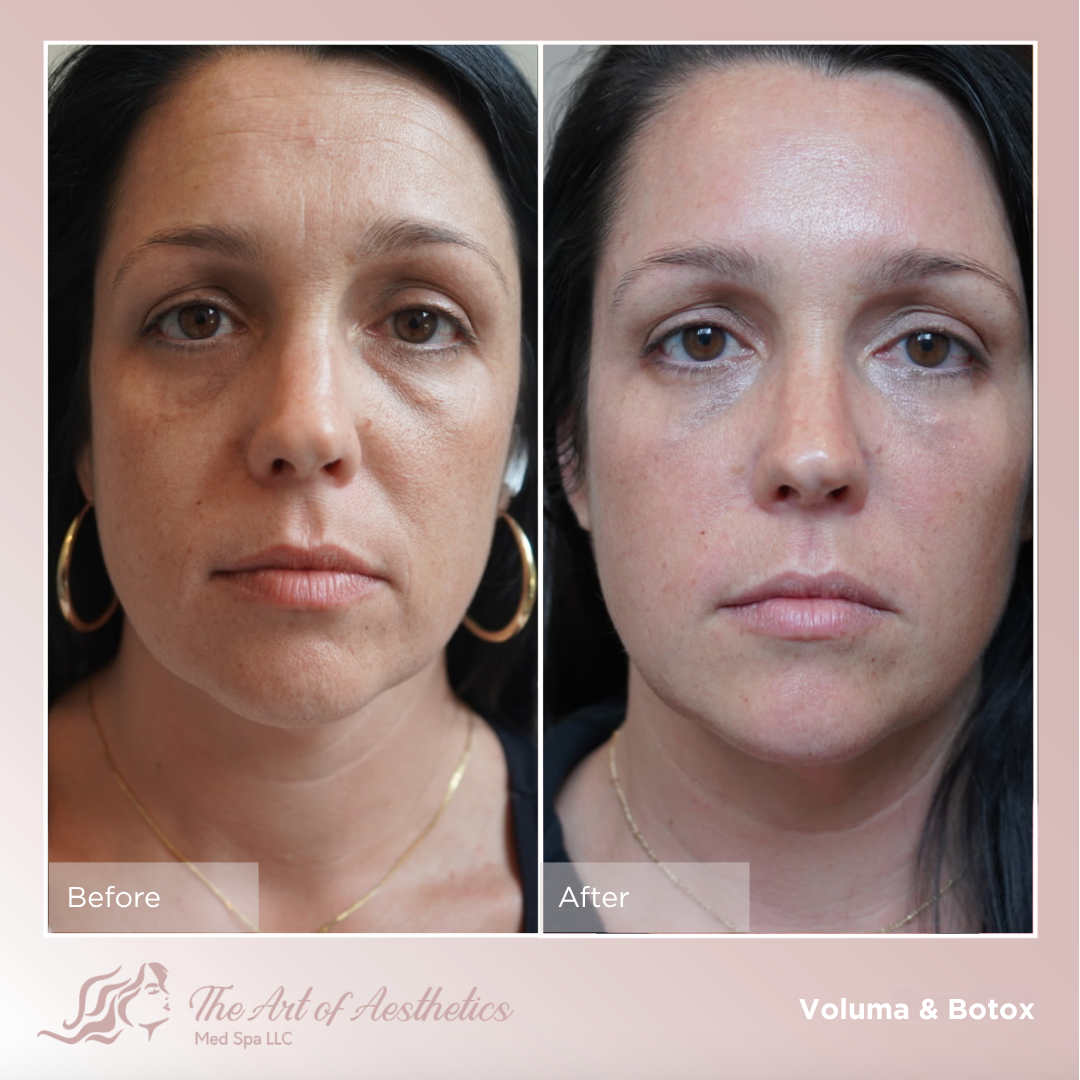 Facial Balancing with Scar Revision (8).png
