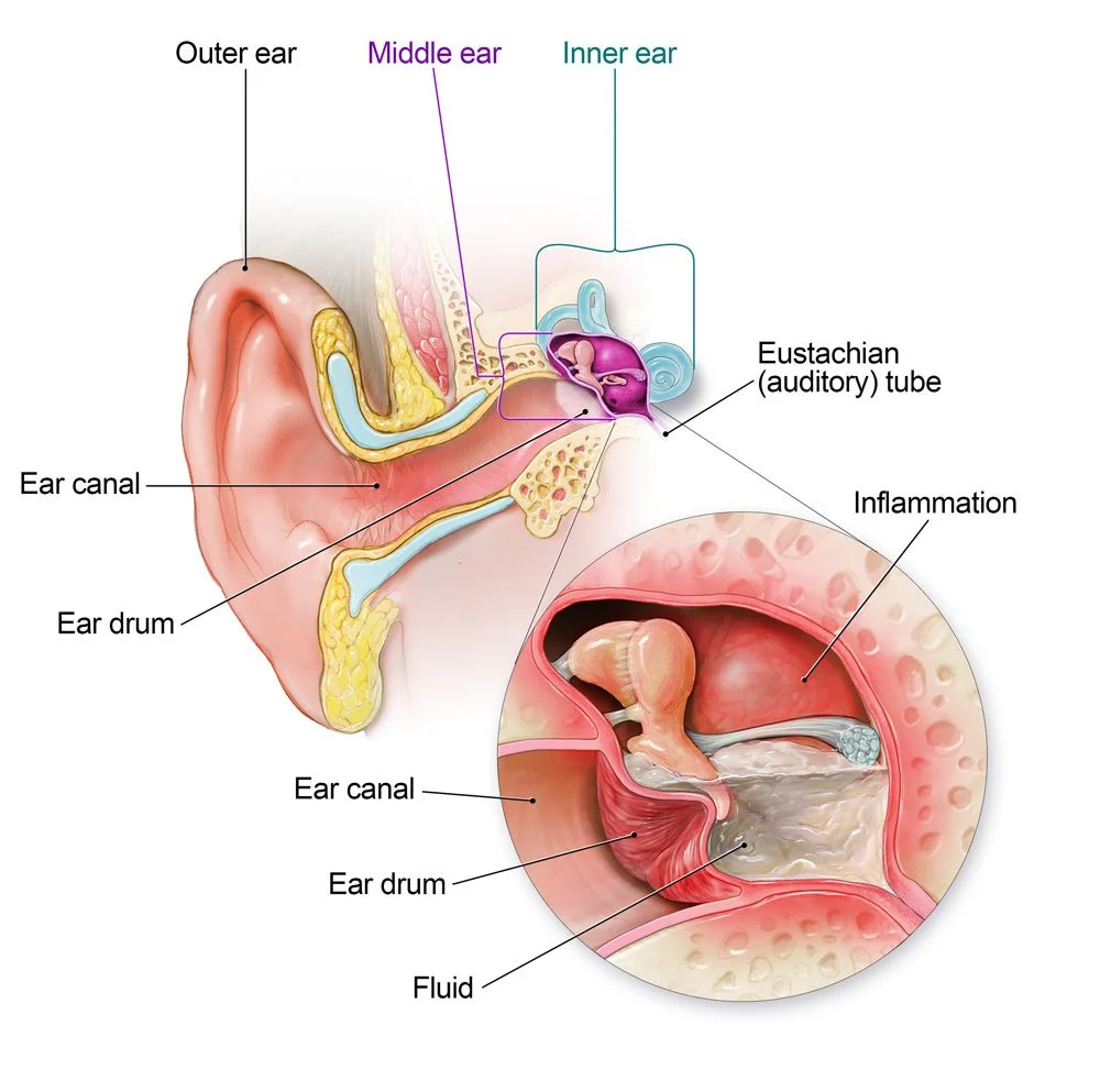 Middle Ear Infection - Acute Otitis Media