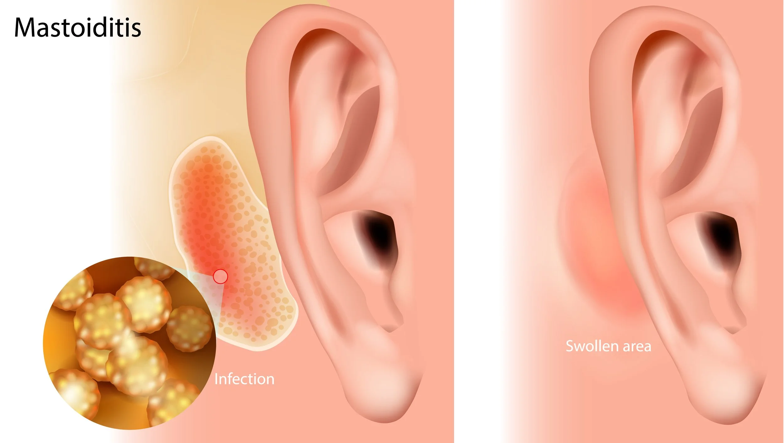Mastoid bone, acute mastoiditis, extracranial complication otitis media