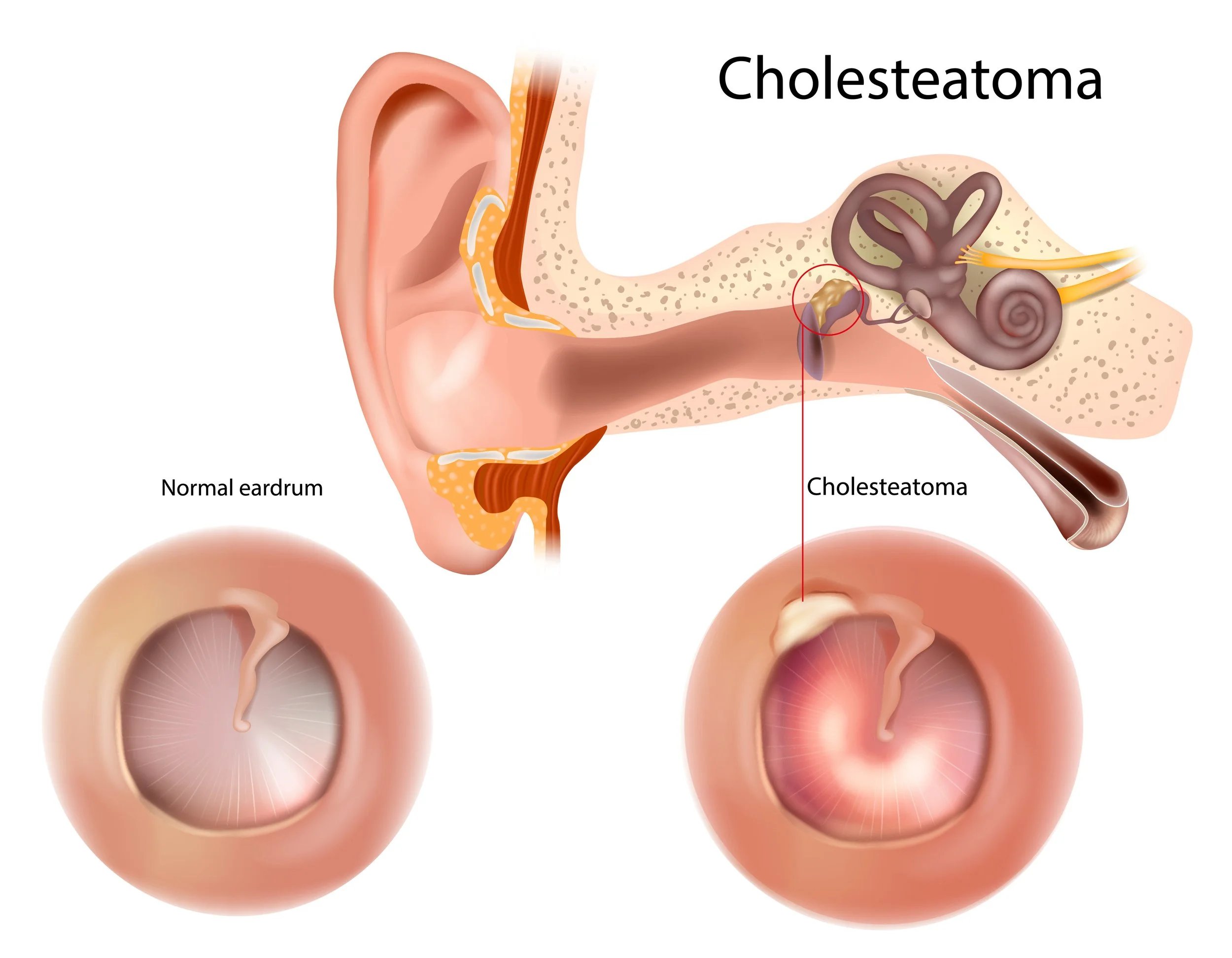 Cholesteatoma, abnormal accumulaiton of skin cells behind the eardrum