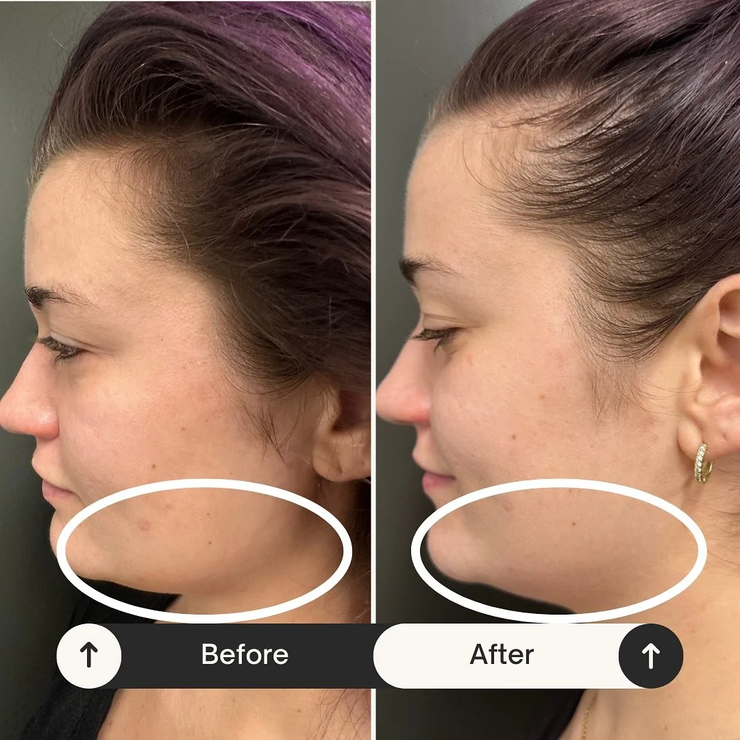 Subtle yet big differences in just one Buccal Massage Signature Facial. Combining the transformative technique of TCFM (Therapeutic &amp; Corrective Facial Massage) externally, we promote myofascial release to be able to work efficiently in the mouth