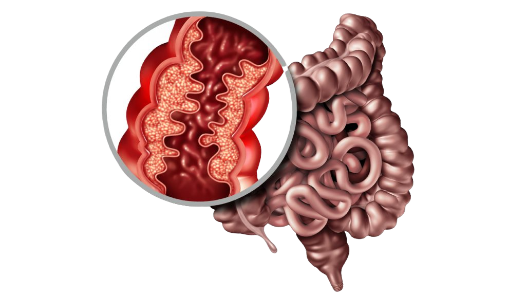 Enfermedad de Crohn