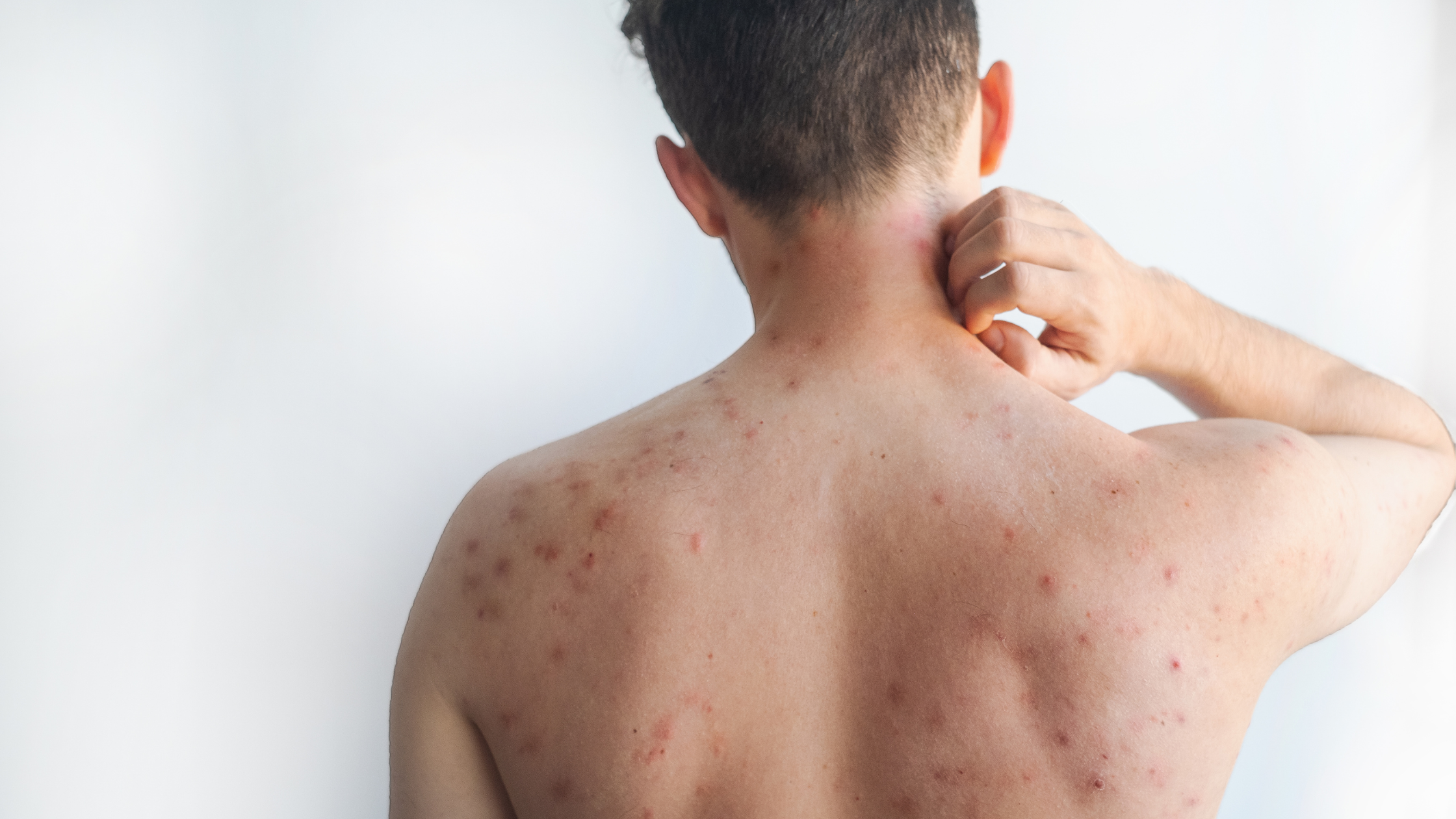 Cómo la toxicidad crónica del níquel en alimentos saludables puede desencadenar erupciones cutáneas inexplicables