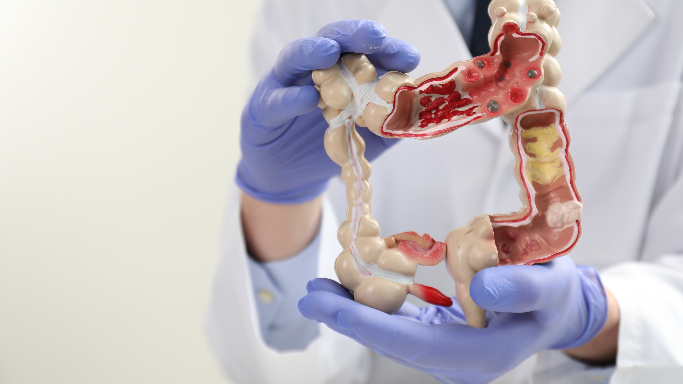 Cómo la estenosis y la cicatrización crónica se relacionan con los niveles de permeabilidad intestinal
