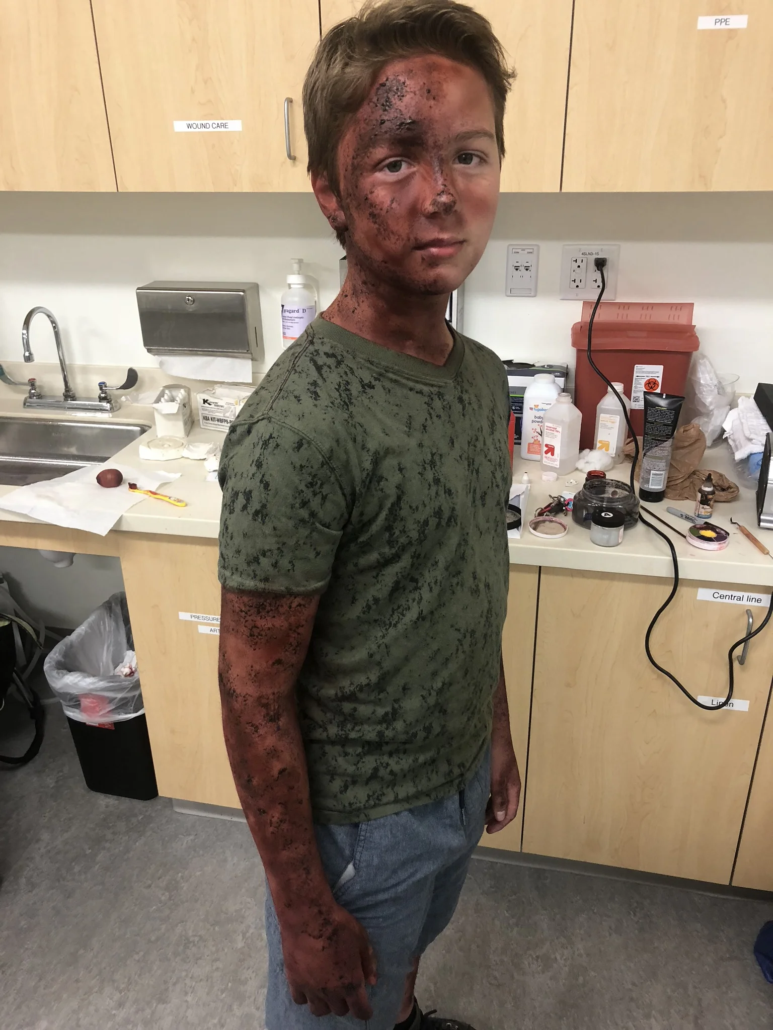 OHSU burn victim for SIM Lab