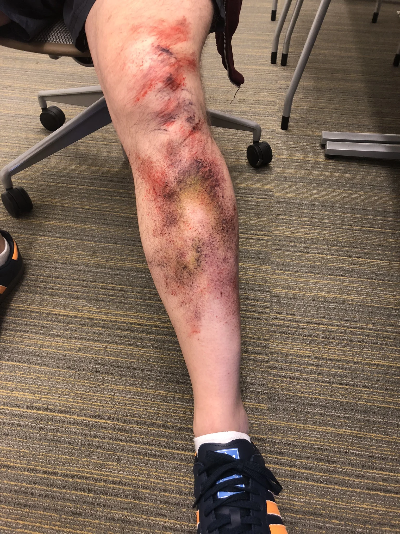 OHSU SIM-bruising, crush bruising