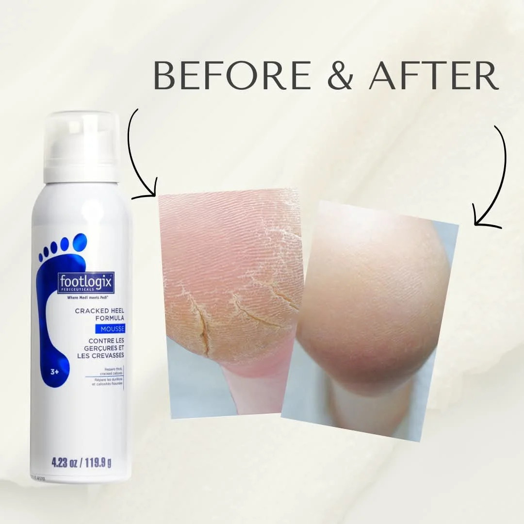 Footlogix Cracked Heel Formula (125 ml)