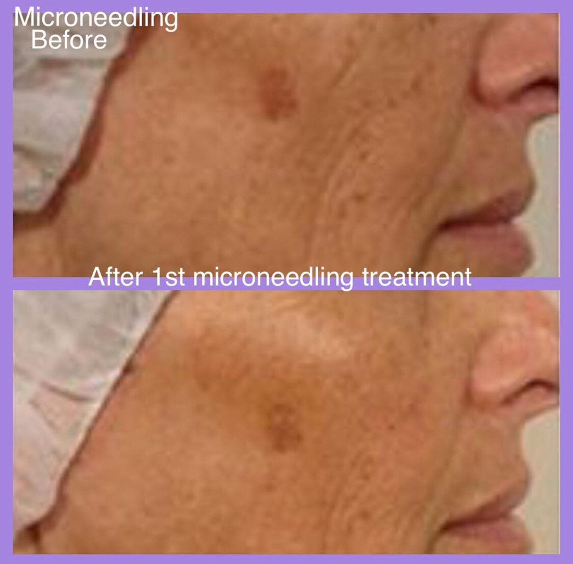Side-by-side comparison before and after microneedling treatment on facial skin, highlighting texture improvement.