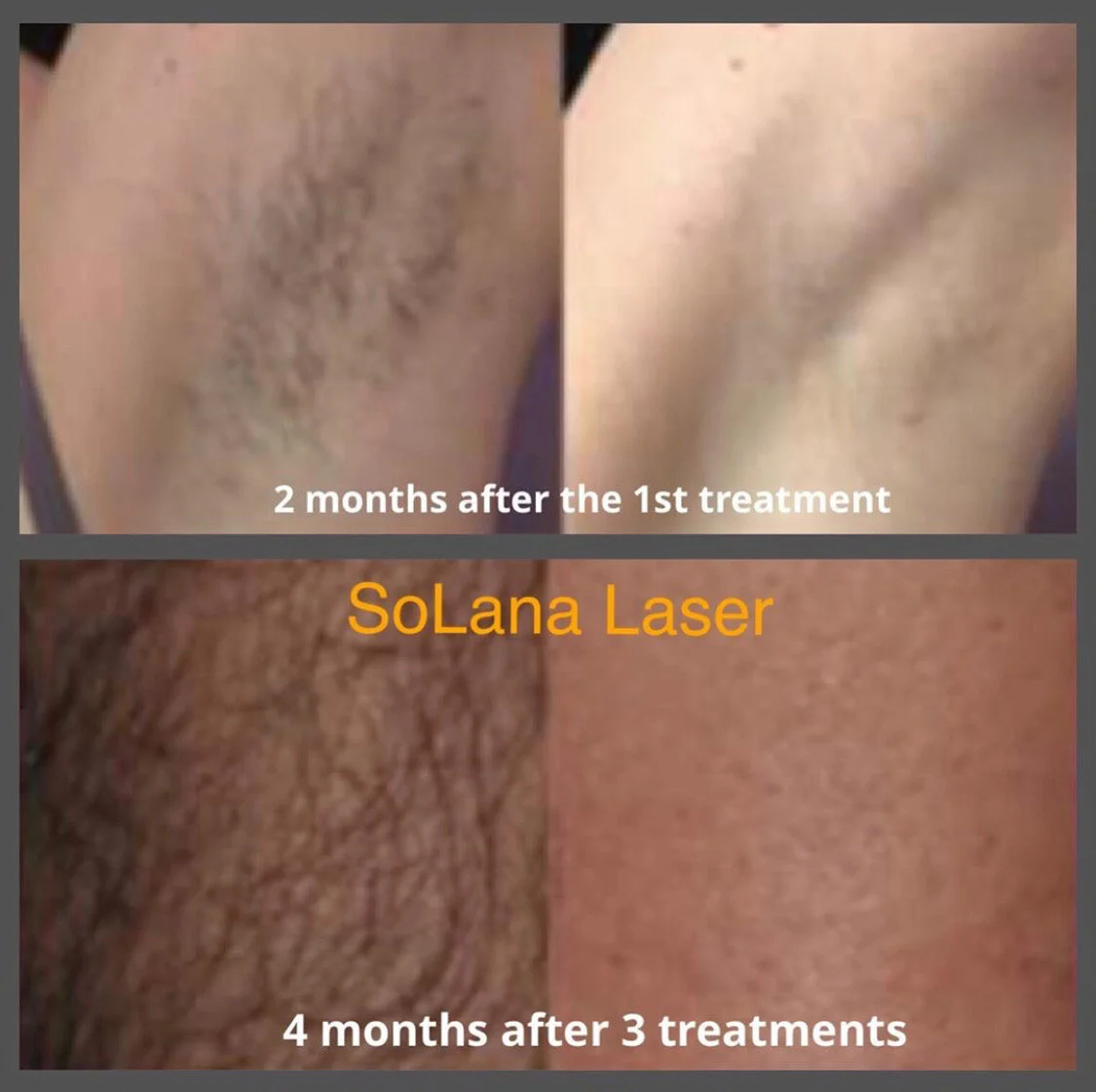 Comparison of underarm and skin hair reduction before and after SoLana Laser treatments, showing visible hair decrease over time.