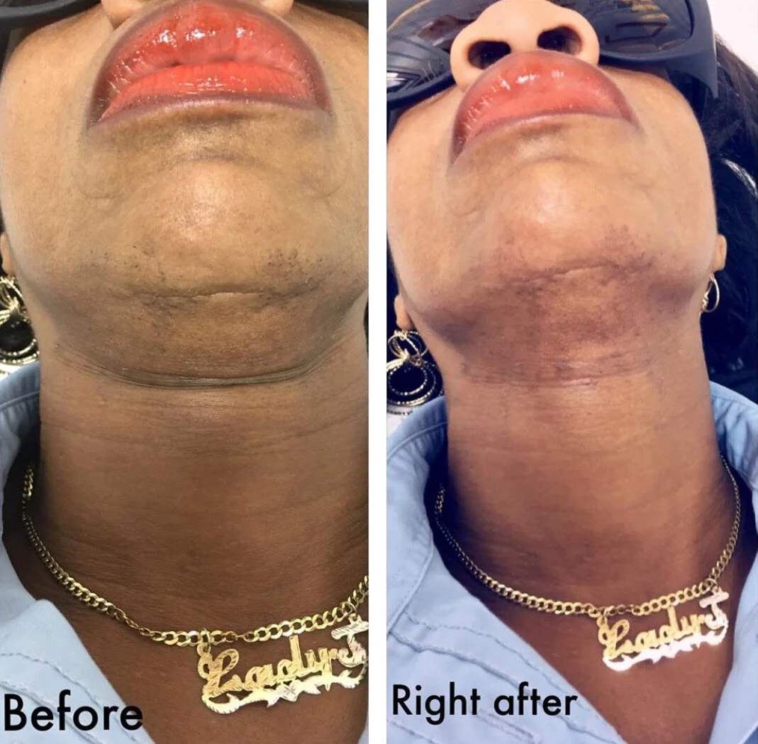 Comparison of a woman's chin and neck area before and after a skincare or cosmetic treatment, showing smoother skin texture in the "right after" image.