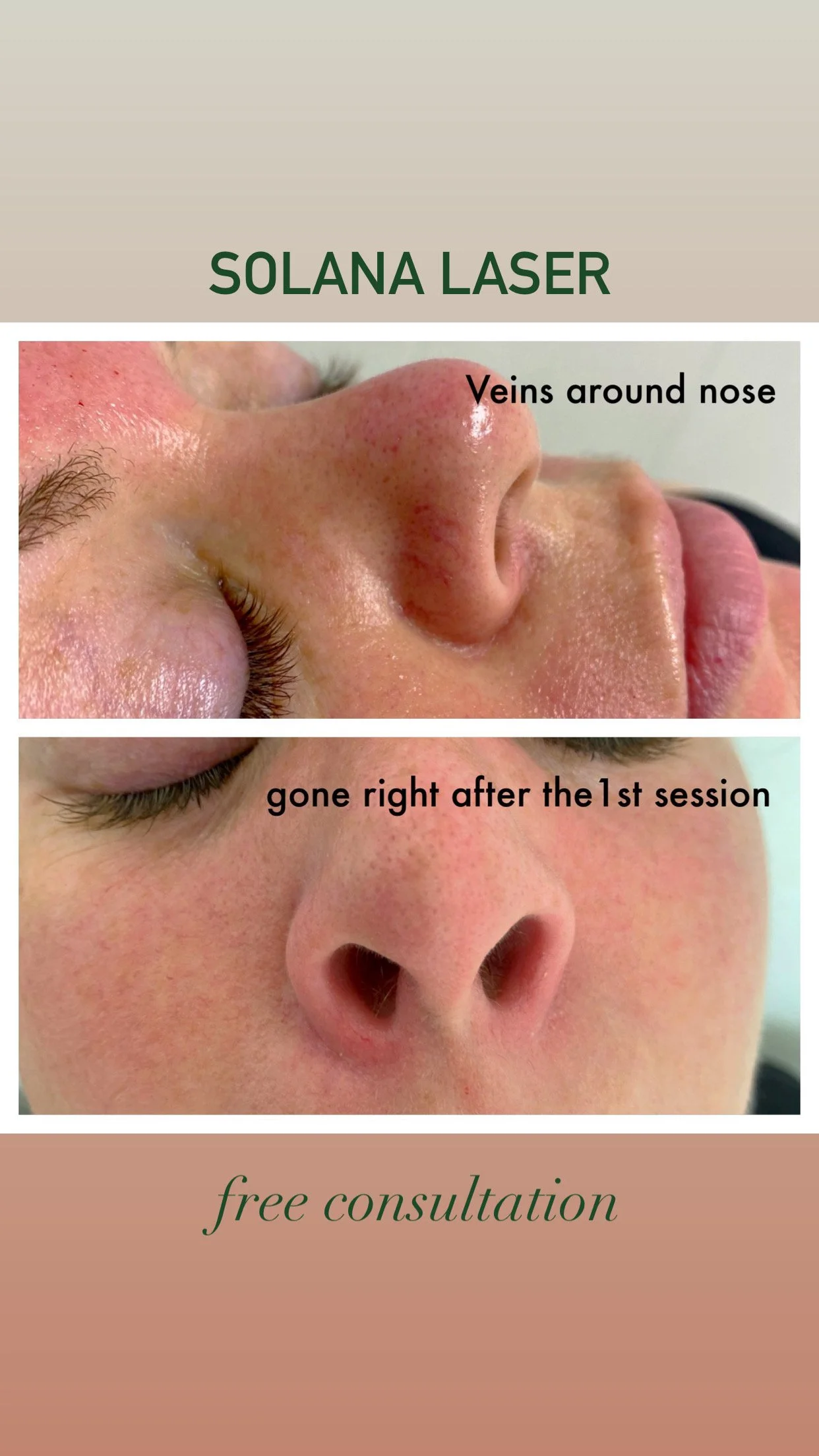 Comparison of skin before and after laser treatment showing reduced veins around the nose. Text includes "SOLANA LASER" and "free consultation."