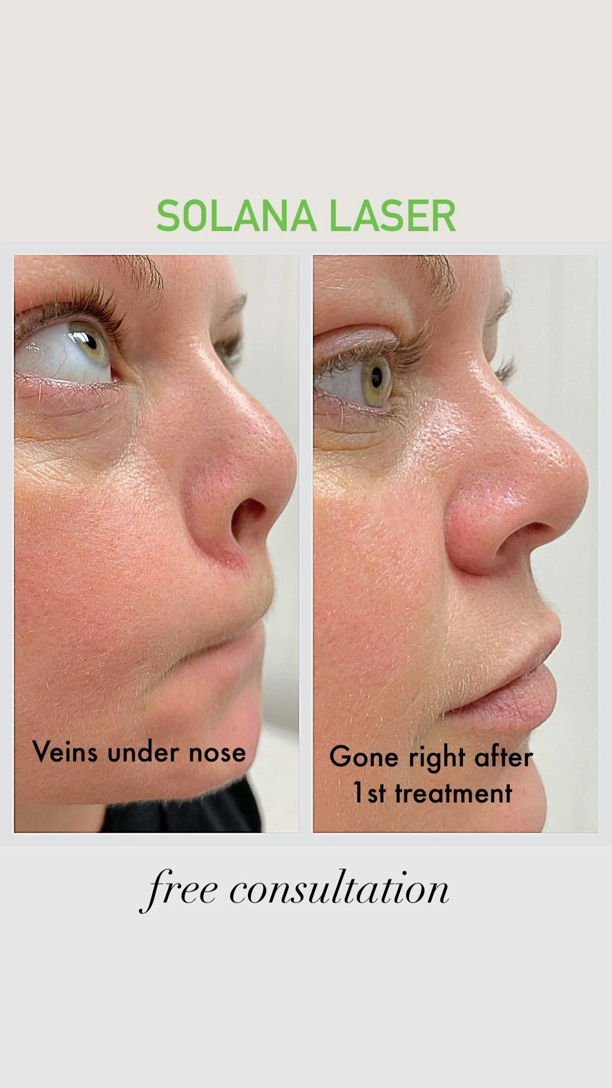 Before and after comparison of vein treatment under the nose using Solana Laser, with an offer for a free consultation.