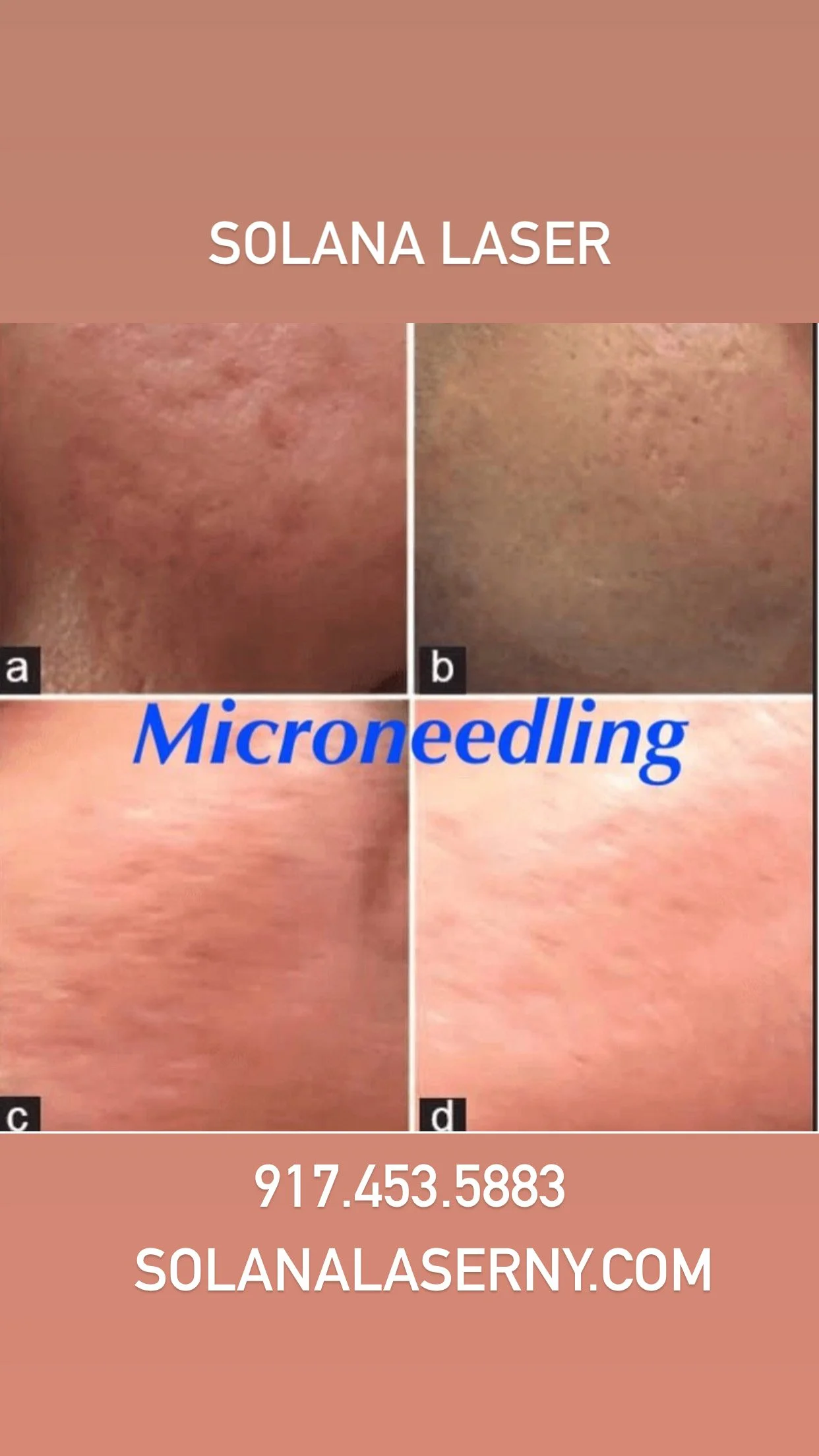 Collage of skin before and after microneedling treatment, labeled "Solana Laser." Includes contact information and website for Solana Laser NY.