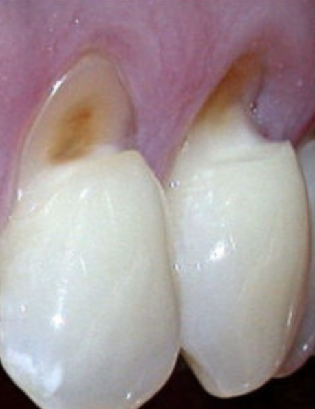 Indflydelse . konsol Tooth Wear : Over Brushing — Homegirl Hygienist