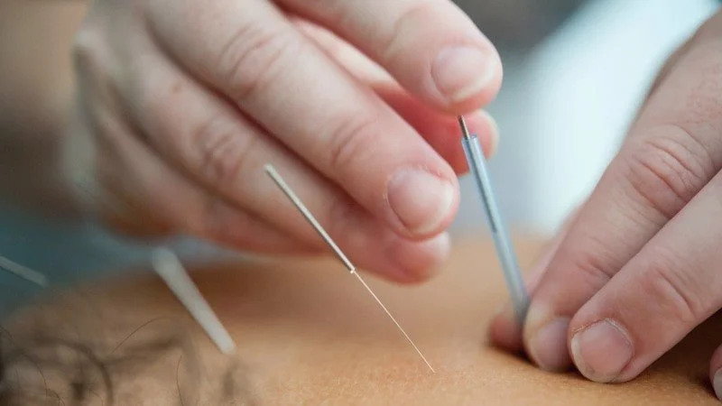 Alternativ behandling - akupunktur