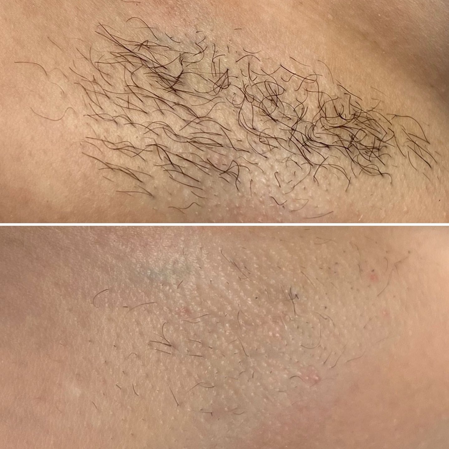 Now is the time to start your Laser hair reduction if you want to chuck out that razor come Summer time! 😎 ☀️ &hellip; What&rsquo;re you waiting for?!