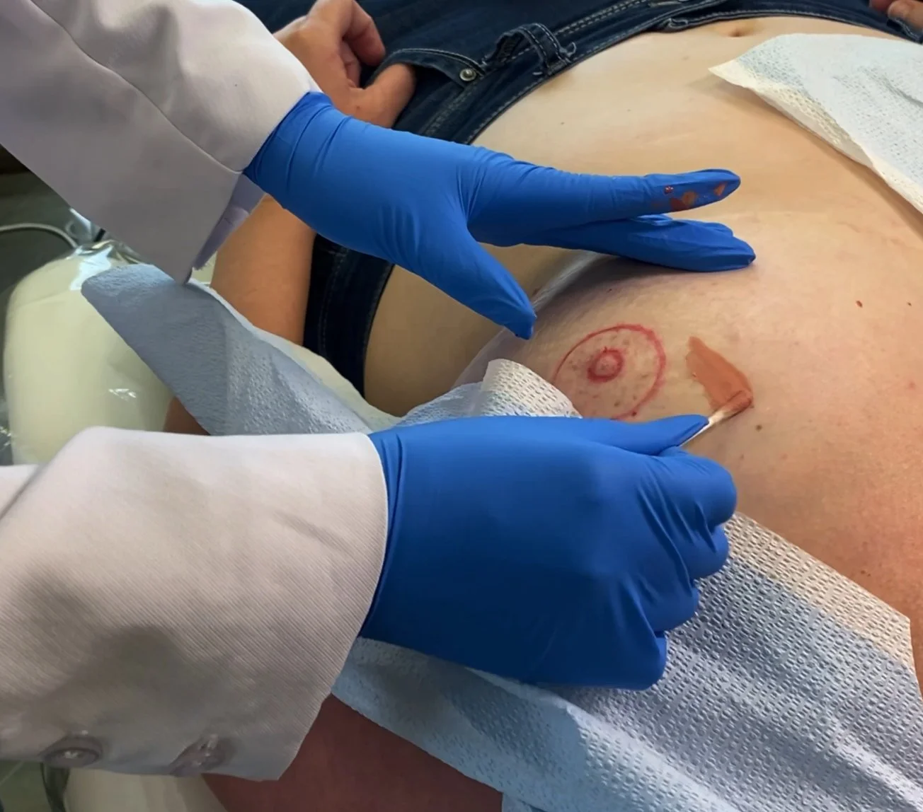 Person applying antiseptic on abdomen with gloved hands