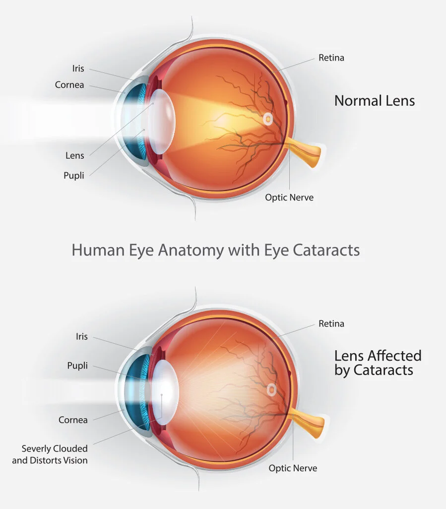 Eye Conditions & Treatments — Cataract and Eye Consultants of Michigan