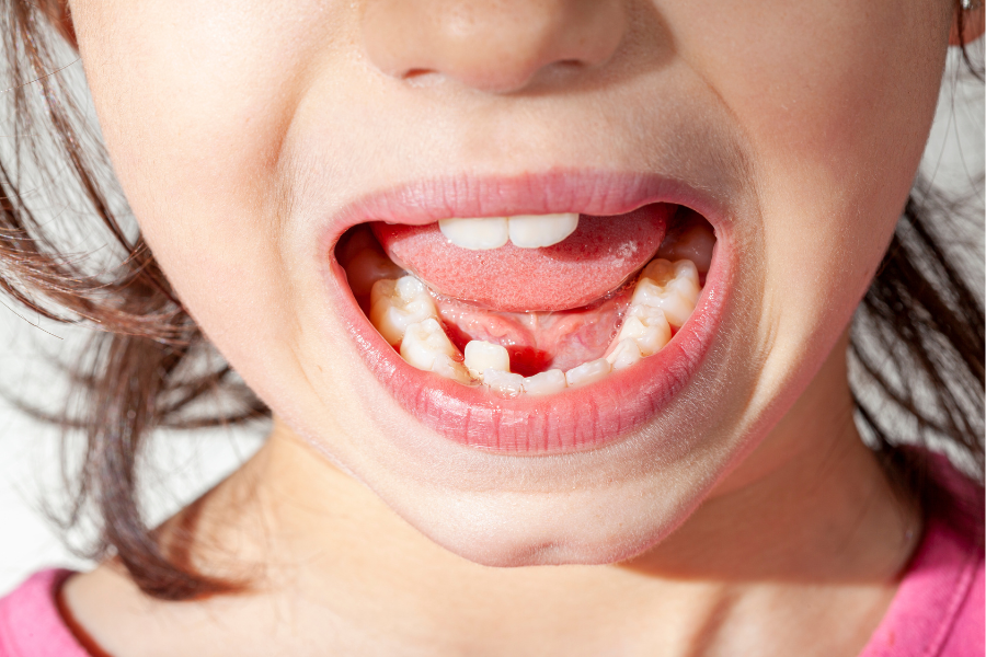 Close-up of a child's open mouth showing missing teeth and a new adult tooth growing in.