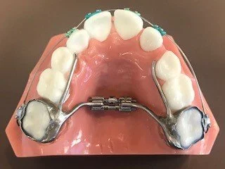 A dental model demonstrating the use of a palatal expander device attached to the upper teeth and palate.